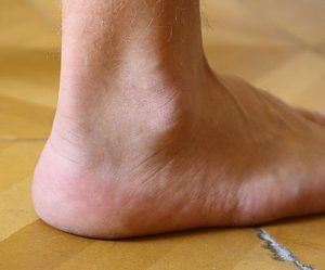 Картинка: Голеностопный сустав