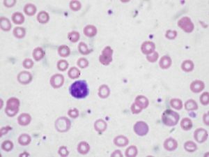 Картинка: Анемия