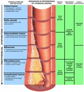 Картинка: Атеросклероз